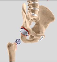 revision hip replacement