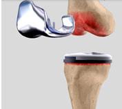 Revision Knee Replacement